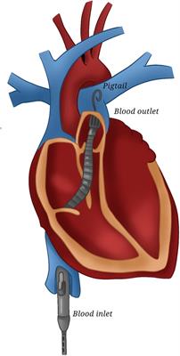 Current and future options for adult biventricular assistance: a review of literature